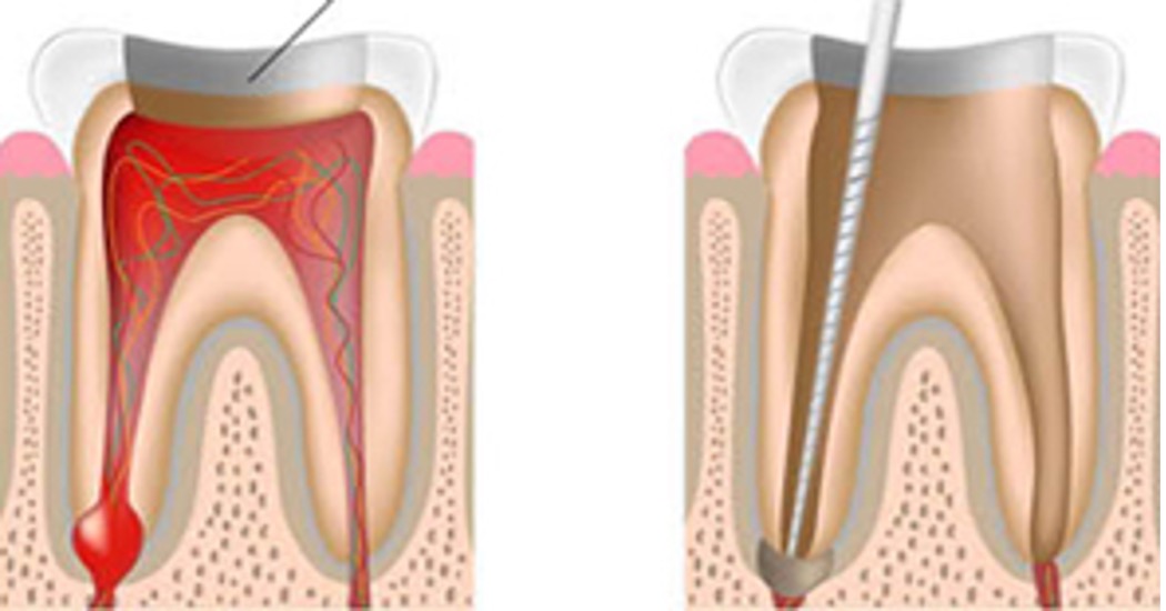 Entzündeter Zahn - Wurzelbehandlungsinstrument im Wurzelkanal