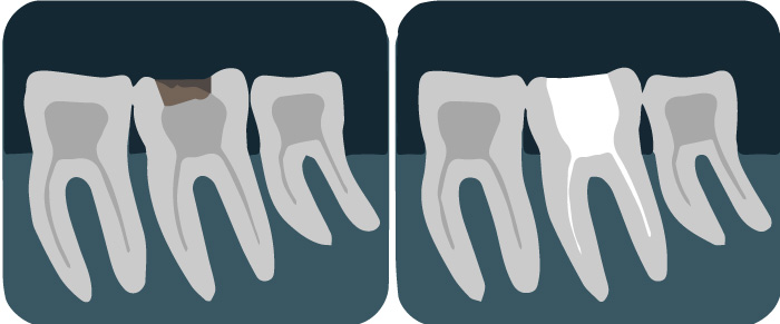 Zahn mit Füllung und Pulpa (Nerv) - Danach: Zahn mit Wurzelfüllung 