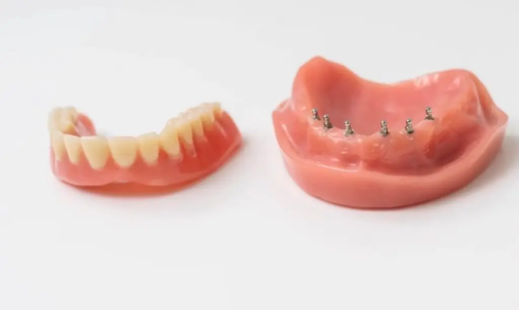 Mini Implantate Zahnersatz mit Zahnprothese in Basel