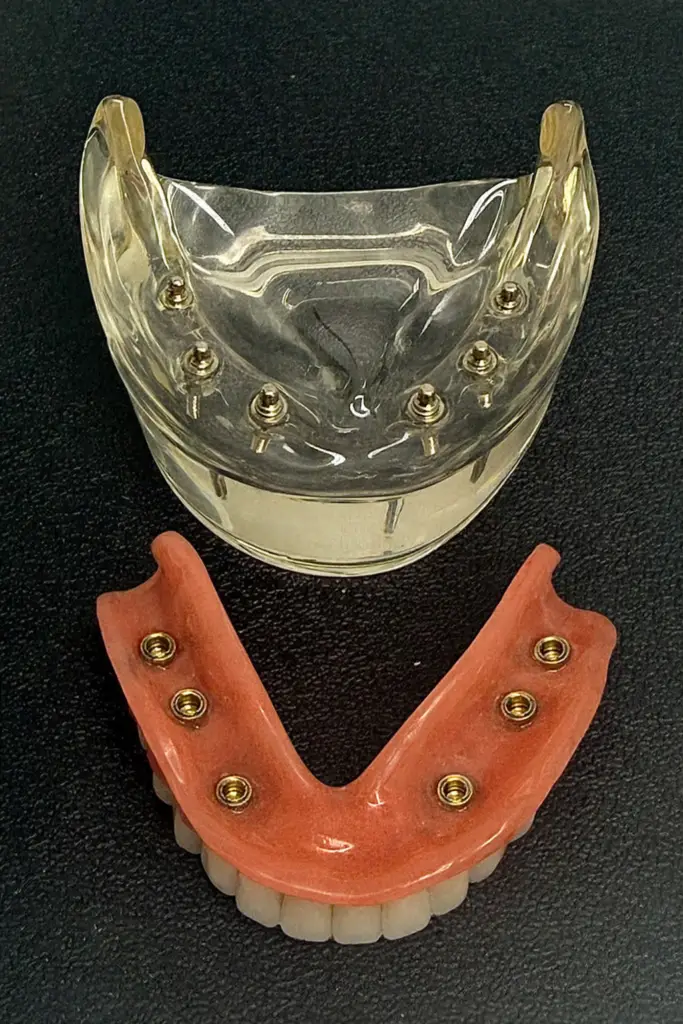 Implantatgetragene Zahnprothese in Basel