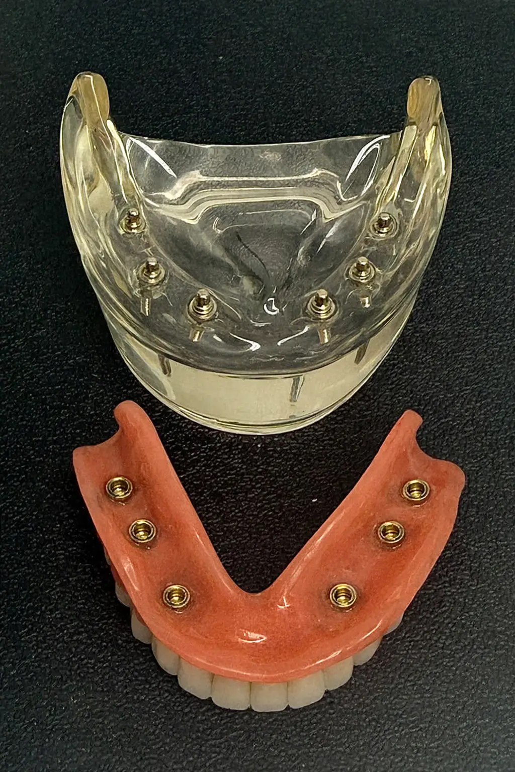 Implantatgetragene Zahnprothese in Basel