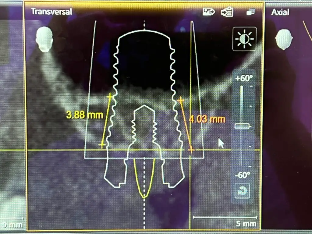 3D-Röntgenaufnahme (DVT/CBCT) mit geplantem Implantat